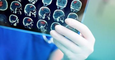 Домедична допомога при гострому мозковому інсульті: що важливо робити і від чого слід утриматися