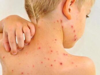 Кір, краснуха та паротит: що потрібно знати про небезпечні хвороби