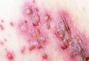 Захистіть Дитину Від Вітряної Віспи:  Вакцинація – Надійний Спосіб Профілактики